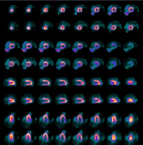 D-SPECT Series Page Case2 Image2 Digital