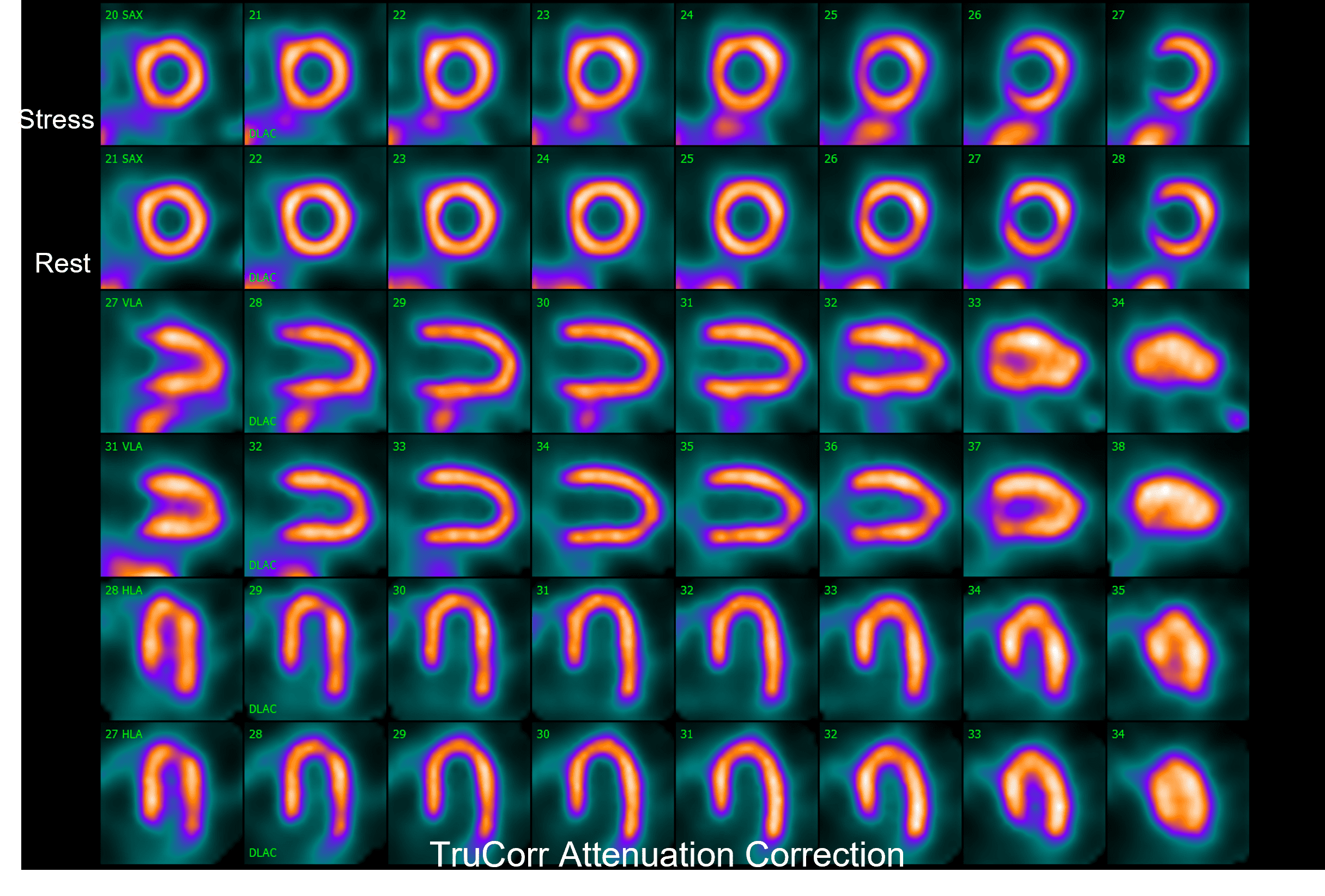 TruCorr 1