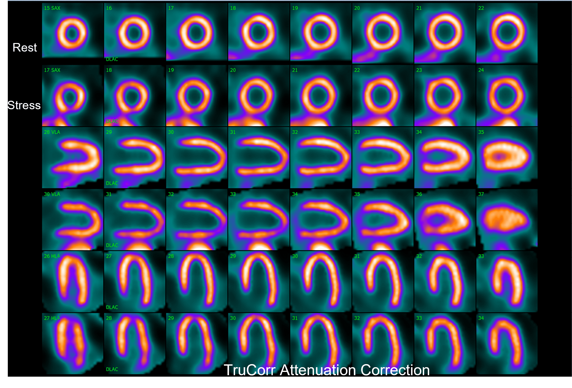 Trucorr 3